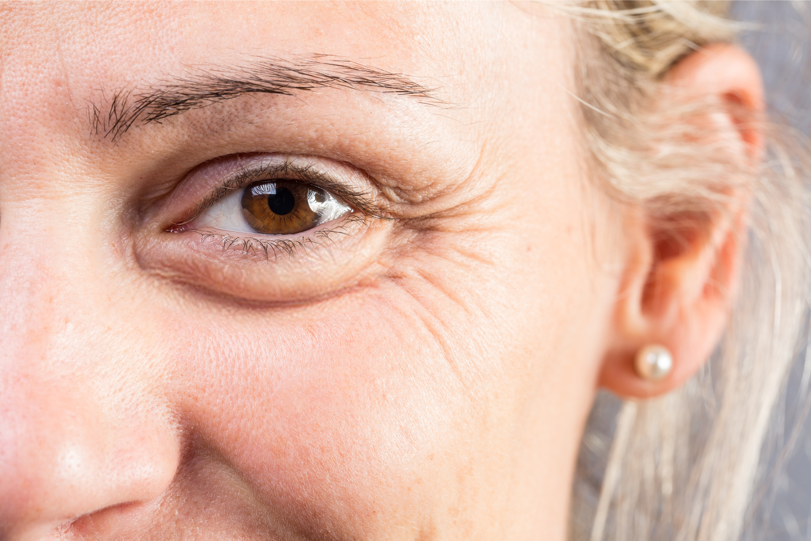 Botox for crow’s feet around the eyes, Nottingham MD