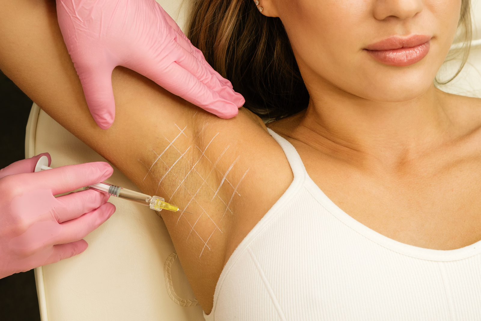Botox for hyperhidrosis (excessive sweating), Nottingham MD