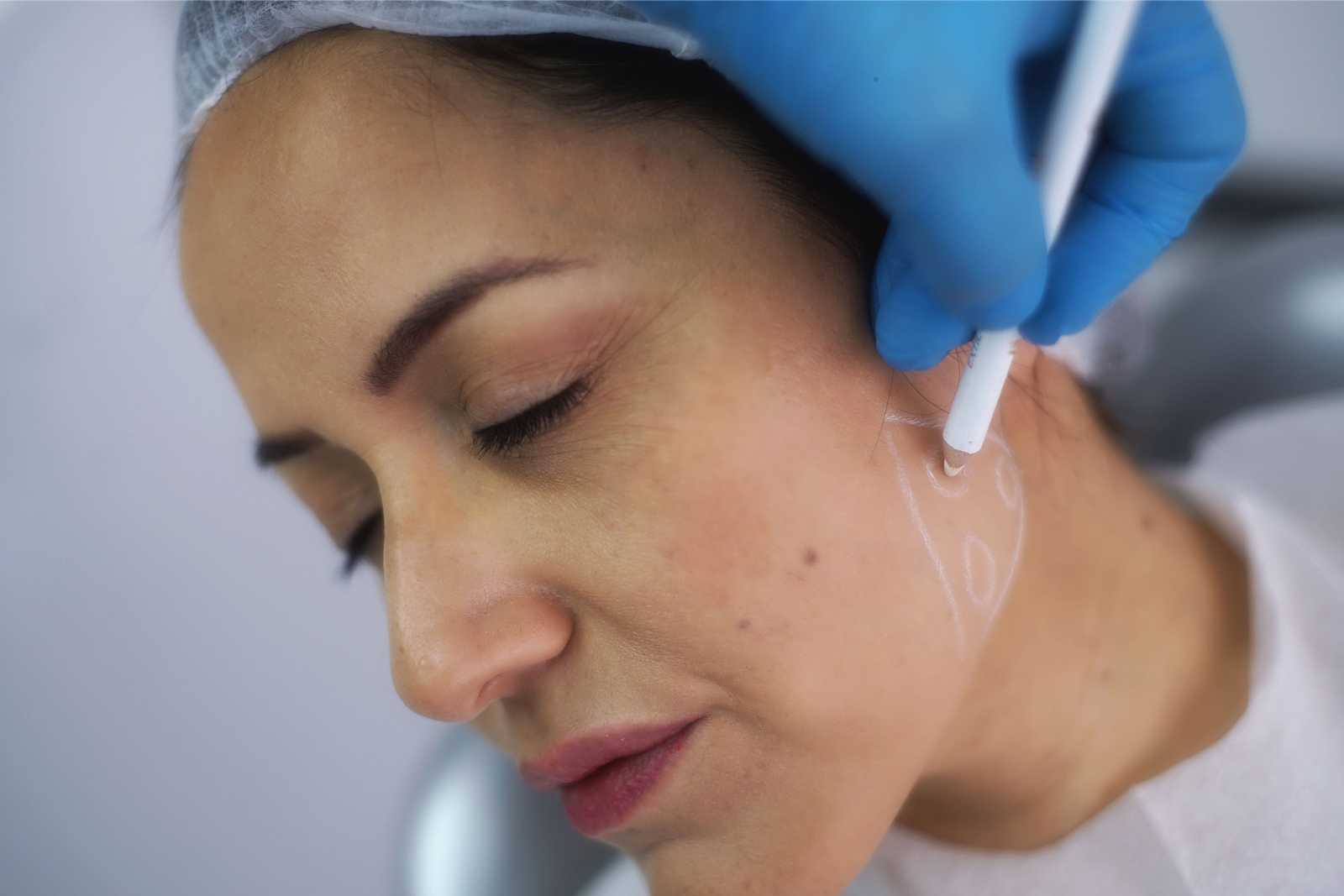 Jawline filler for a defined, contoured jaw, Nottingham MD