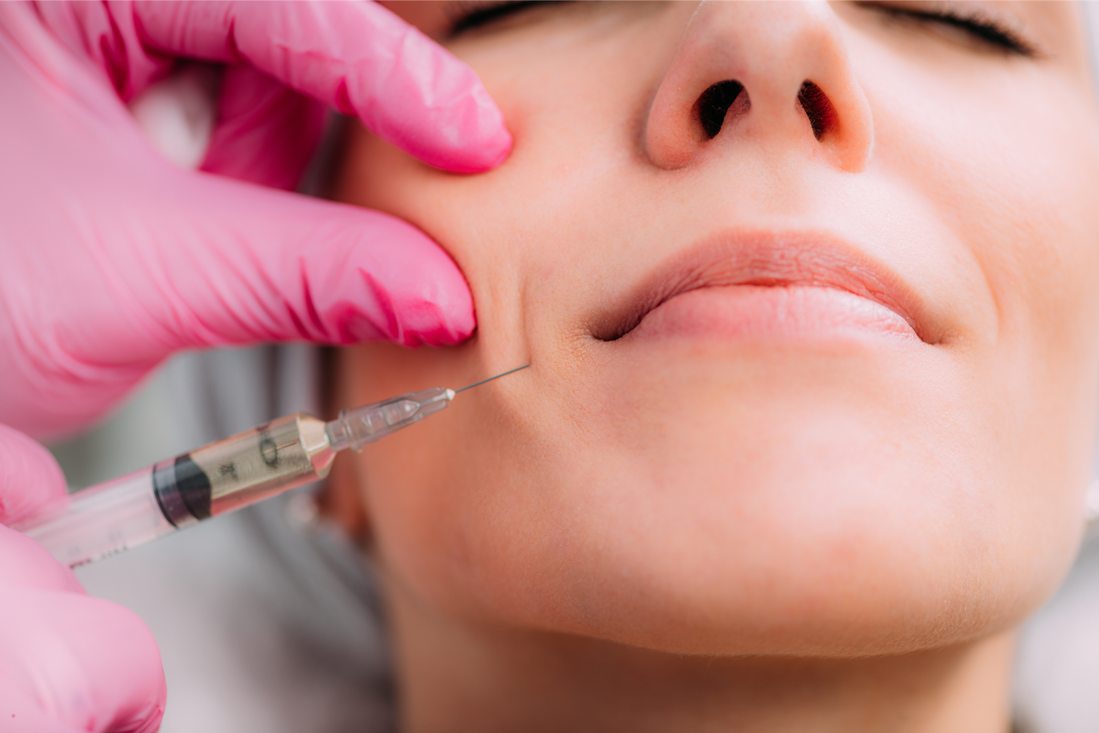 Nasolabial filler to soften smile lines, Nottingham MD