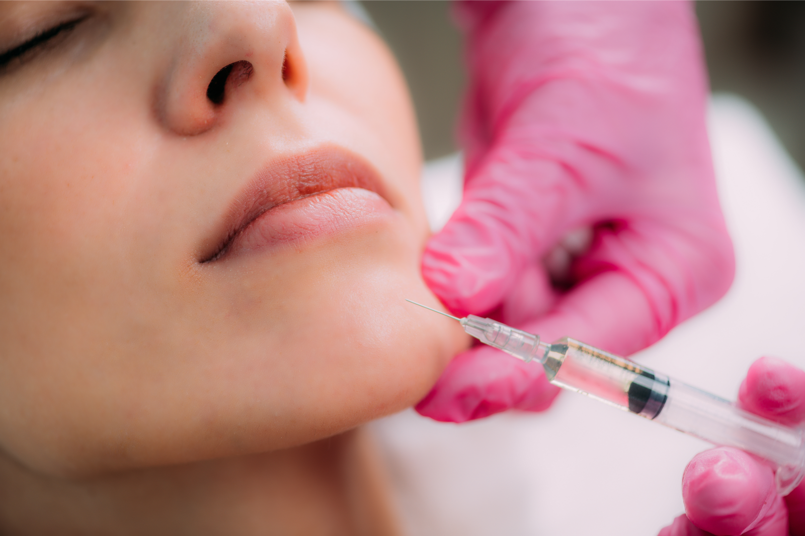 Chin filler to balance the profile, Nottingham MD
