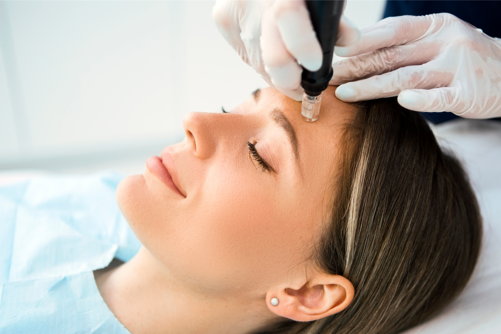 Microneedling collagen induction treatment, Nottingham MD