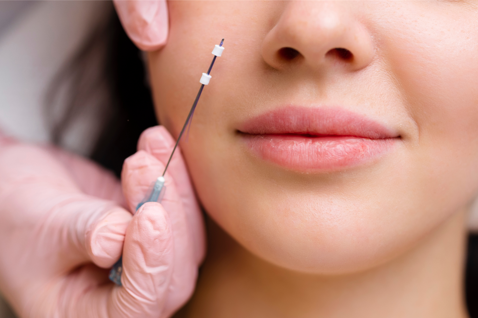 Non-surgical PDO thread lift for the face, Nottingham MD